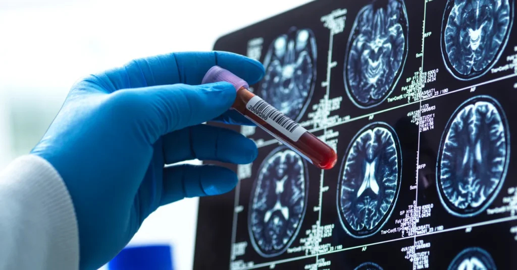 Blood Exams for Alzheimer’s Are Right here Blood Tests for Alzheimer’s Are Here
